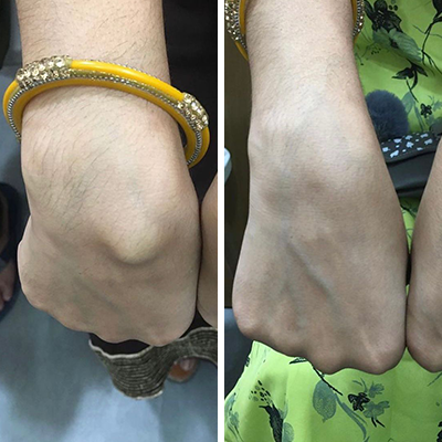 Ganglion or Nodules or Lipomas